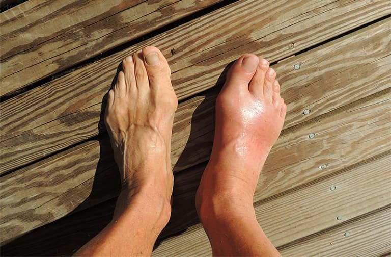 Ở giai đoạn cấp tính, tay chân người bệnh bắt đầu bị phù nề, tấy đỏ