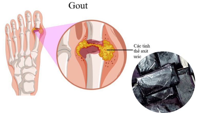 Cải thiện hiệu quả gout và nhiều bệnh xương khớp khác