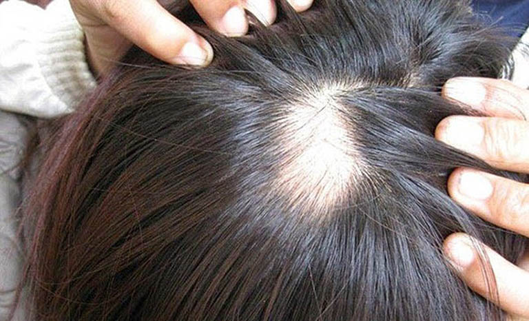 Rối loạn nội tiết tố nữ cũng là nguyên nhân gây rụng tóc tuổi dậy thì