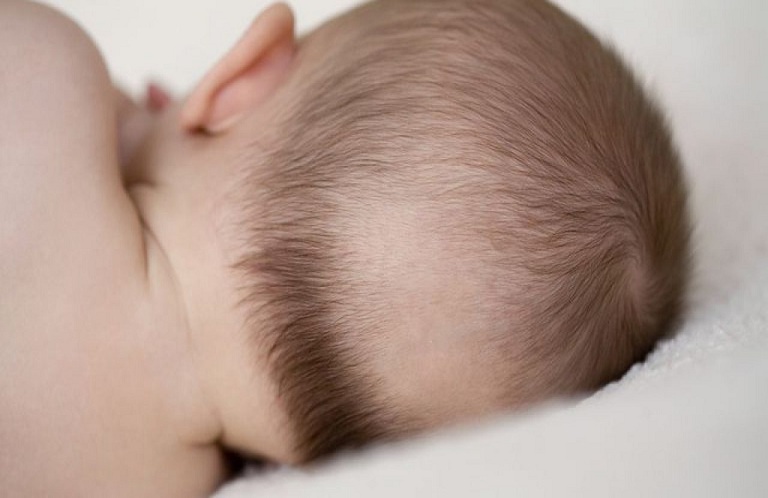 Rụng tóc vành khăn là tình trạng gặp ở trẻ giai đoạn sơ sinh