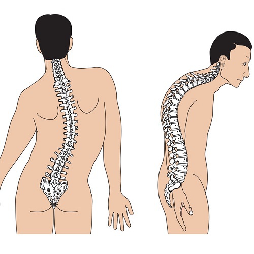 Lưng người bệnh hướng về phía trước nhiều hơn hoặc cong vẹo sang một phía