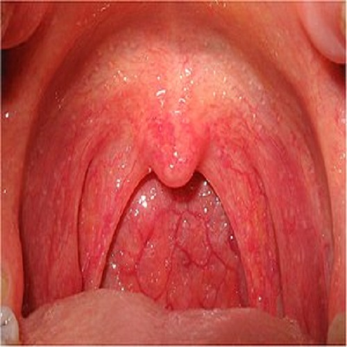 Viêm họng kéo dài ảnh hưởng không nhỏ đến cuộc sống người bệnh