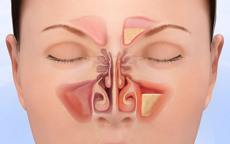 Viêm xoang ở mũi là bệnh phổ biến, xảy ra ở nhiều đối tượng