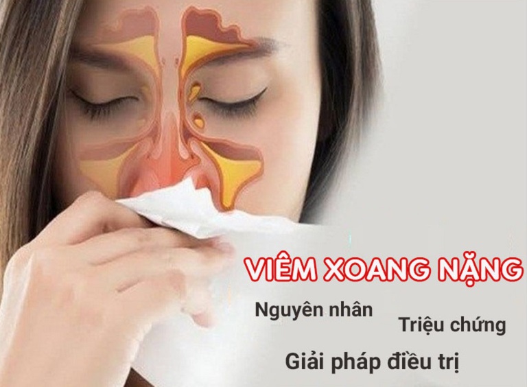 Viêm xoang nặng là tình trạng lớp lót niêm mạc trong tại các khoảng trống trong mũi bị viêm