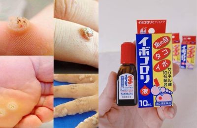 Thuốc trị mụn cóc của Nhật (Ibokorori) có hiệu quả không?