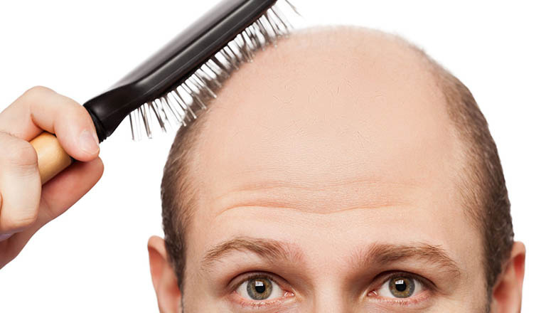 Hói đầu là tình trạng tóc rụng nhiều dẫn tới các mảng trắng da đầu