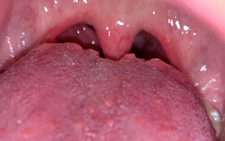 Viêm họng hạt ở cuống lưỡi