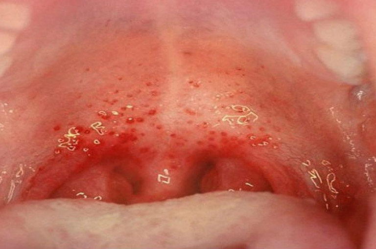 Viêm họng liên cầu khuẩn