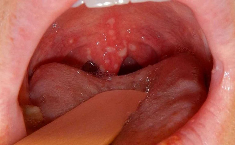 Phân biệt viêm họng hạt và ung thư vòm họng