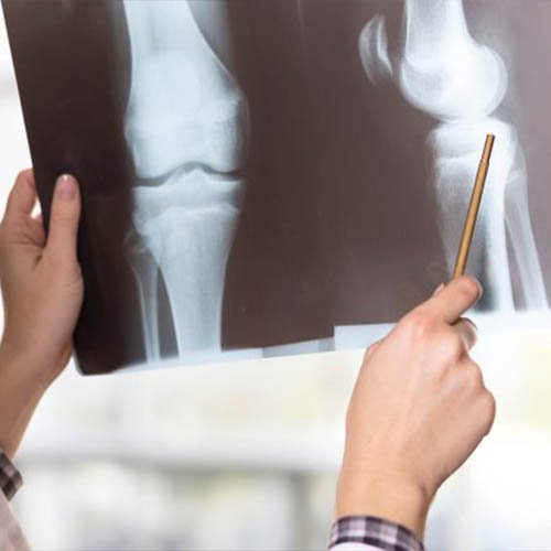 Chụp X-quang được ứng dụng phổ biến trong chẩn đoán khô khớp