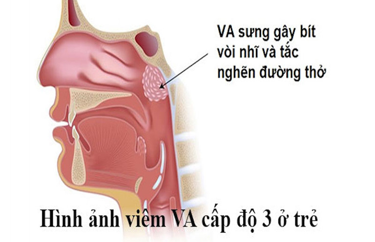 Viêm cấp khiến VA sưng tấy dẫn đến tắc nghẽn đường thở