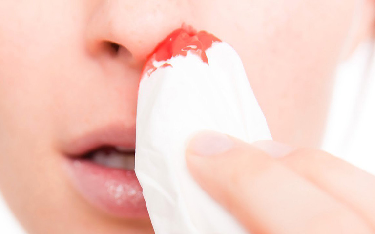 Viêm xoang chảy máu mũi ảnh hưởng đến sinh hoạt và sức khỏe