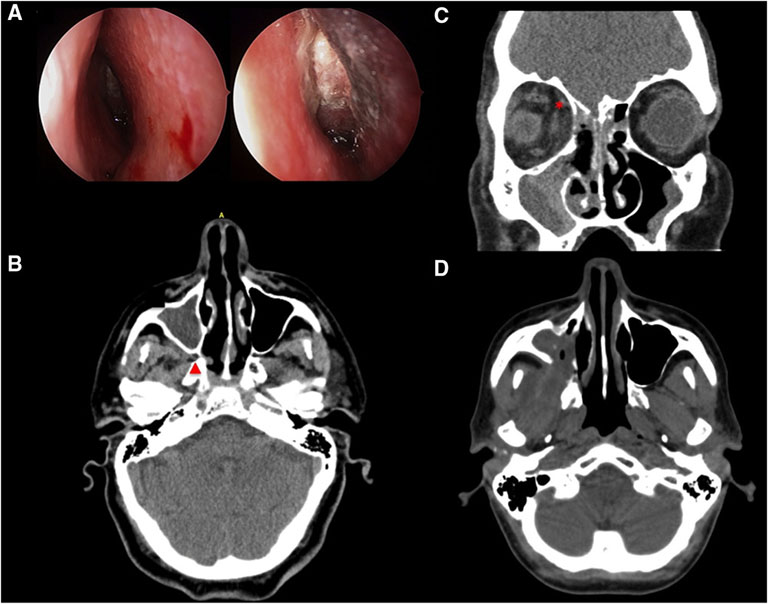 Nội soi mũi và chụp cắt lớp vi tính trong chẩn đoán viêm xoang do nấm