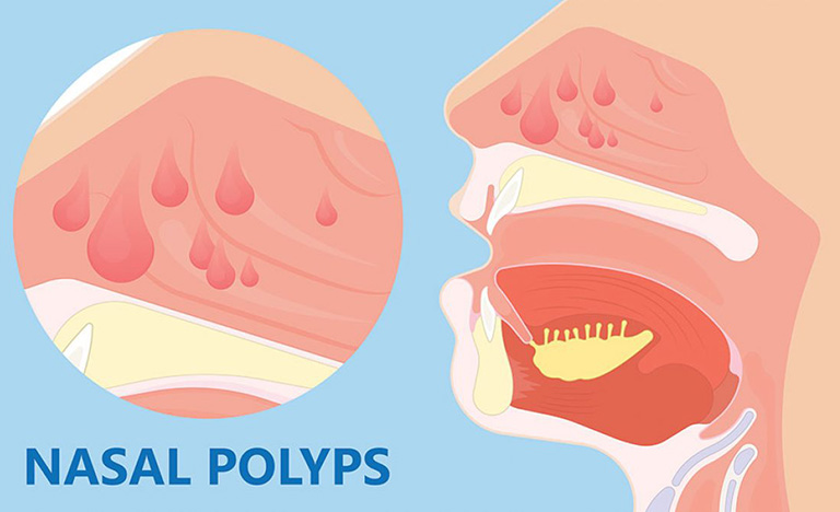 Viêm xoang sàng mãn tính thường liên quan đến polyp mũi