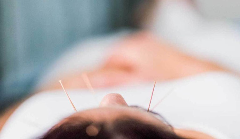 Woman having acupuncture treatment