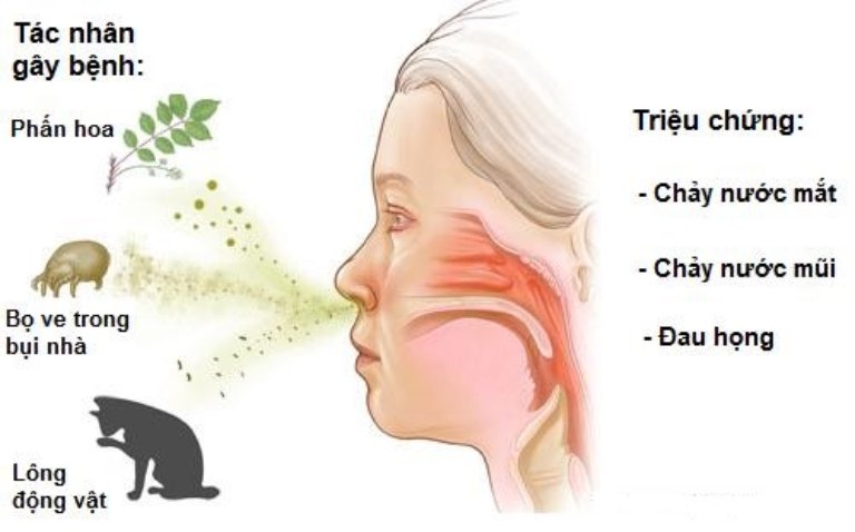 Viêm mũi dị ứng gây ra các vấn đề ở niêm mạc mũi