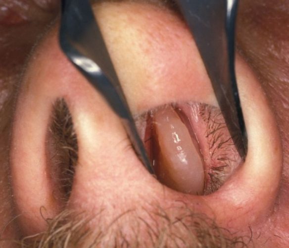 Polyp mũi hoàn toàn có thể tái phát sau khi mổ
