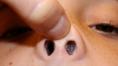 Polyp mũi là một khối mềm, tròn nhỏ bên trong mũi của trẻ