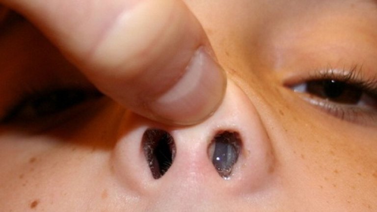 Polyp mũi là một khối mềm, tròn nhỏ bên trong mũi của trẻ