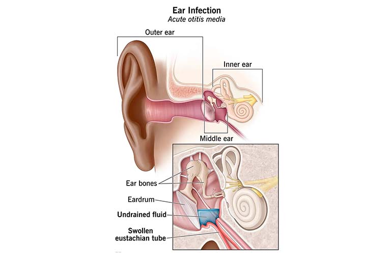bệnh viêm tai giữa