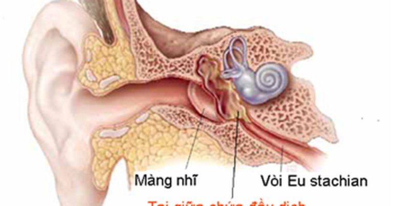 Viêm tai giữa thanh dịch còn được gọi là viêm tai màng nhĩ đóng kín