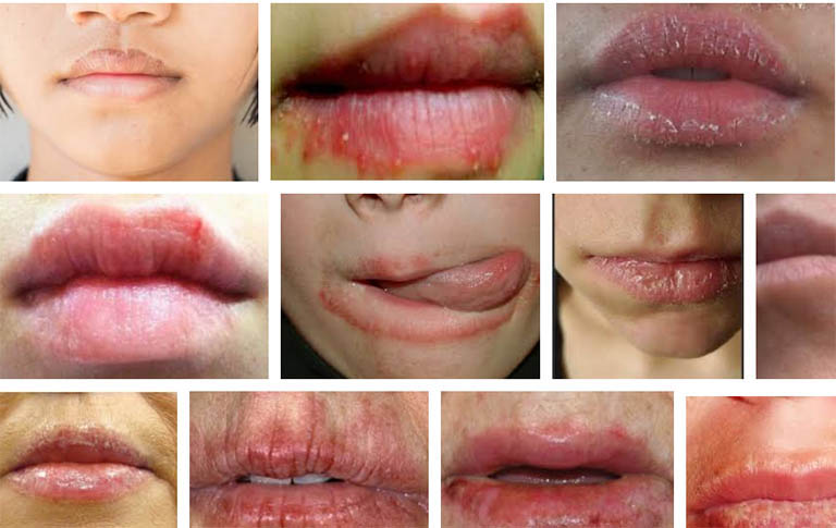 triệu chứng chàm ở môi