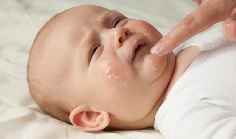 Khi bị chàm, da trẻ rất khô dễ kích ứng, cần được dưỡng ẩm thường xuyên