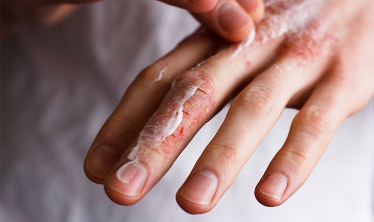 Thoa kem dưỡng ẩm giúp làm dịu tổn thương trên da do bệnh gây ra