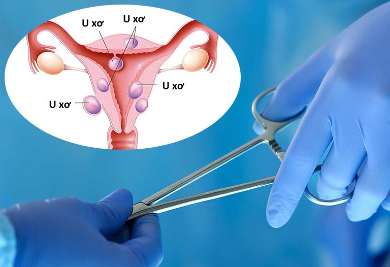 U xơ tử cung thường phải mổ khi có kích thước lớn hoặc nằm ở vị trí khó khăn