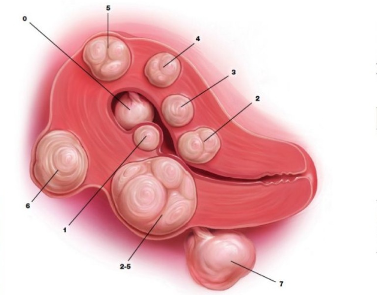 Nhân xơ tử cung có thể được phân loại theo vị trí và kích thước