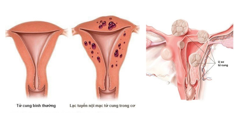 U xơ tử cung và lạc nội mạc tử cung là hai bệnh hoàn toàn khác nhau