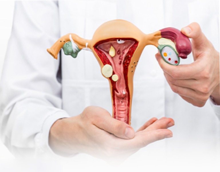 U xơ tử cung và lạc nội mạc tử cung có liên quan đến sự gia tăng nội tiết tố estrogen
