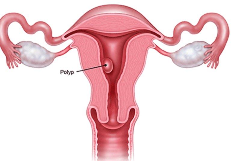 Polyp tử cung có thể là nguyên nhân gây rong kinh ra cục máu