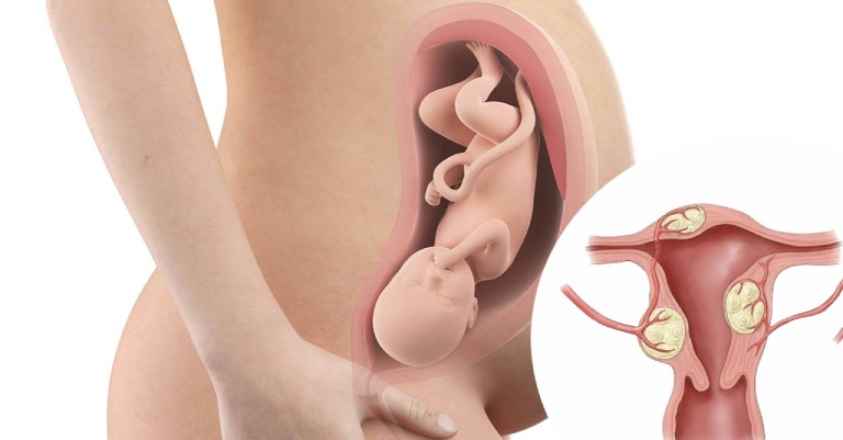 U xơ tử cung có thể ảnh hưởng đến khả năng thụ thai và quá trình mang thai