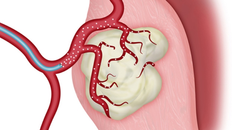 Cách chữa trị triệu chứng đau bụng dưới do u xơ tử cung