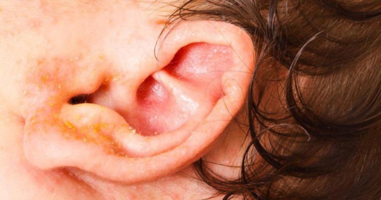 Chàm vành tai ở trẻ sơ sinh có nguy hiểm không?