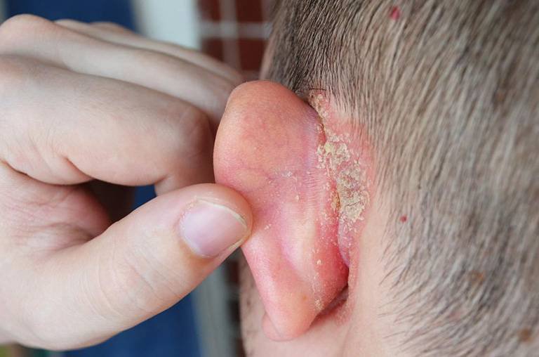 Hình ảnh thực tế của bệnh chàm vành tai