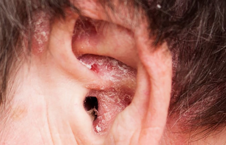 Hình ảnh thực tế của bệnh chàm vành tai
