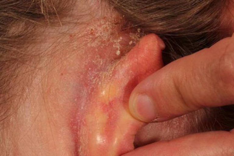 Nguyên nhân gây ra bệnh chàm tai