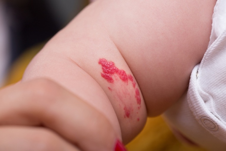 U máu trên da trẻ sơ sinh là u lành tính, thường tự khỏi sau 1 tuổi