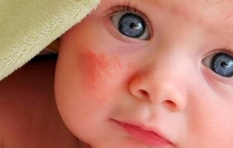 Chàm đỏ ở trẻ sơ sinh là một dị dạng mao mạch máu lành tính